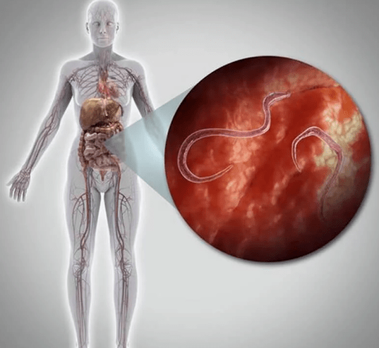 Parasites in the human body