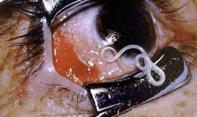 Types of parasites in the human body